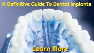 modle jaw with dental implant